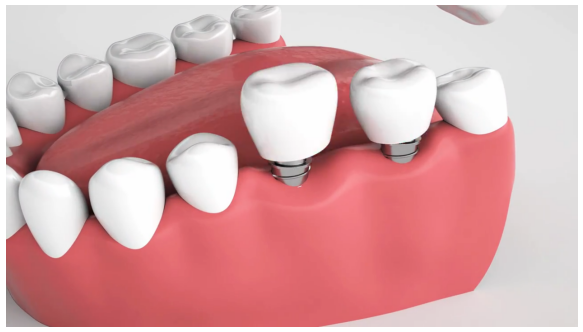 Atometrics Boosts Innovation in Dental Restoration Technology.